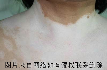 颈部白癜风要怎么科学治疗