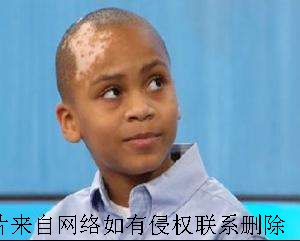 白癜风患者要怎么诊断清楚病情