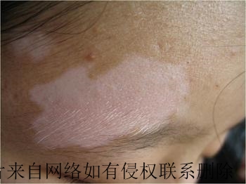 白癜风日常护理注意什么事