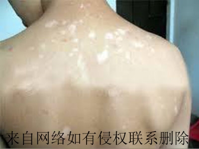 白癜风要如何治疗科学合理